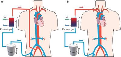 Shear-induced acquired von Willebrand syndrome: an accomplice of bleeding events in adults on extracorporeal membrane oxygenation support